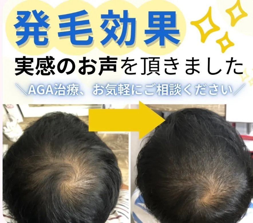 名古屋駅の脱毛サロンがAGA治療薬に医療提携して最安値で提供...